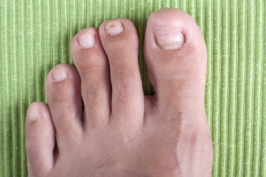 Behandeling ingegroeide nagels – VoetFocus Apeldoorn Medisch pedicure